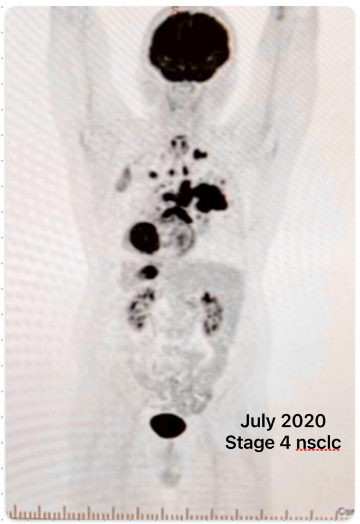 PET Scan July 2020